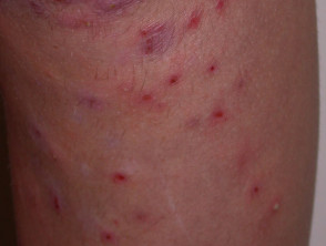Folliculitis due to hair removal
