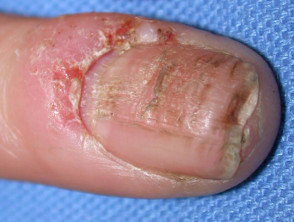 Nail ridges due to eczema