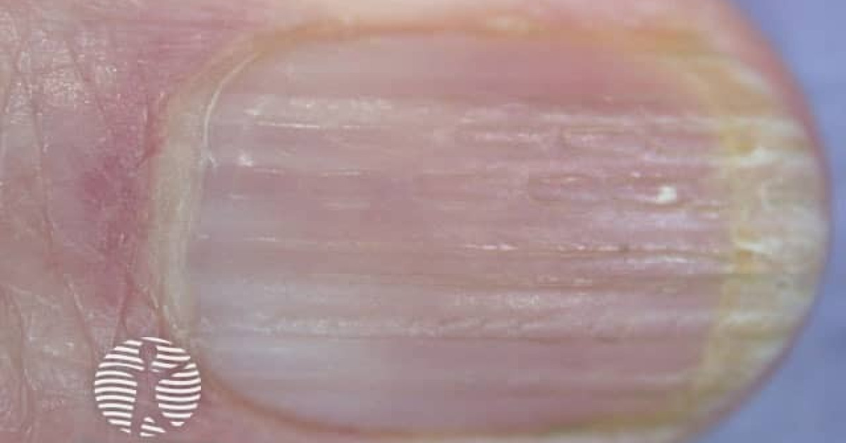 Longitudinal nail ridging image