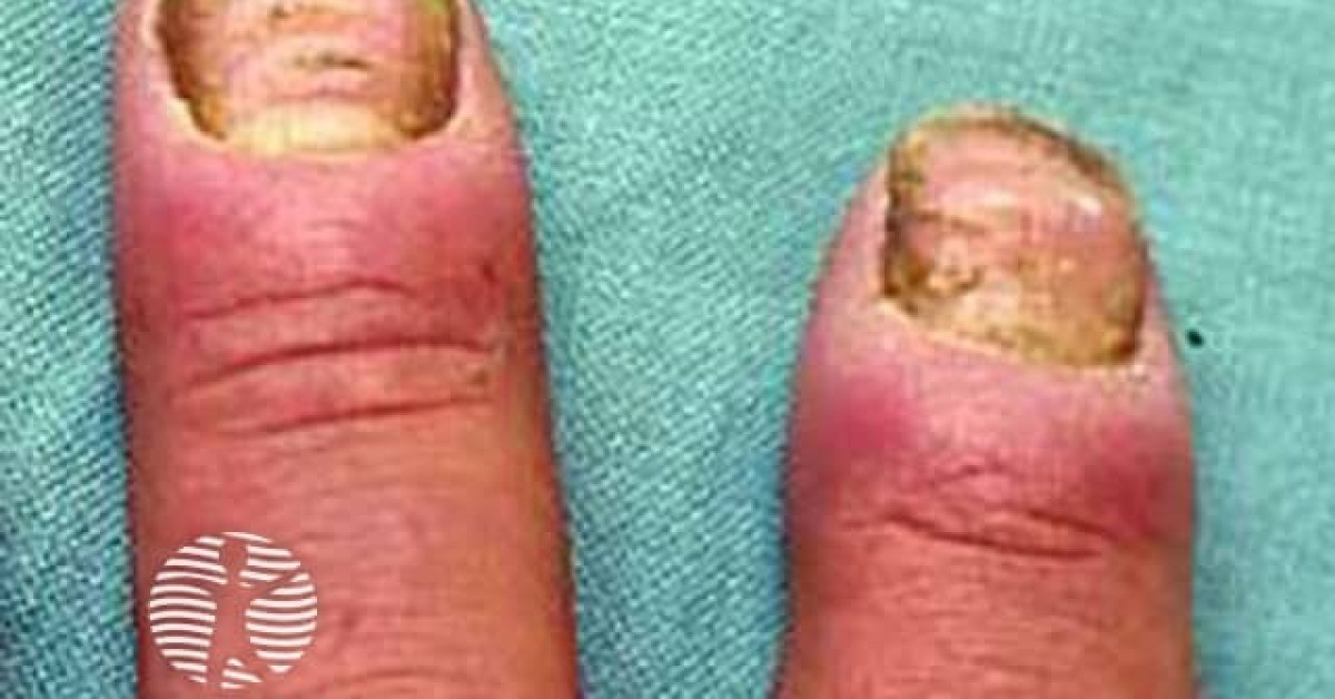 Nail ridging due to eczema image