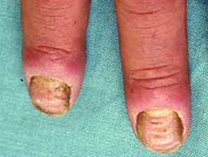 Nail ridging due to eczema