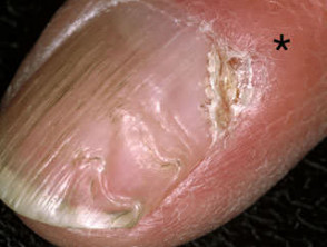 Myxoid cyst