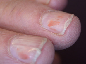 Nail splitting: onychoschizia
