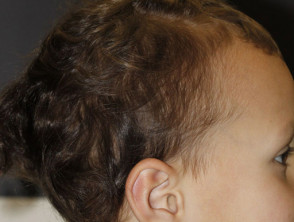 Genes Responsible For Uncombable Hair Syndrome Finds Study