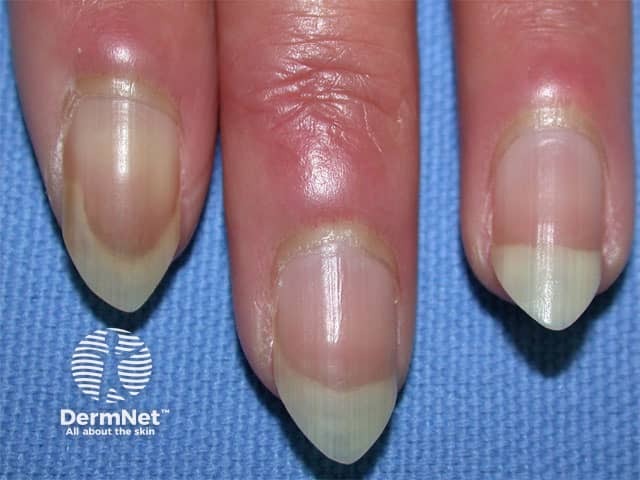 Nail fold telangiectasia