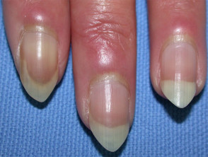 Nail fold telangiectasia