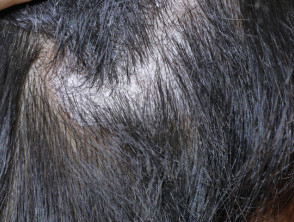 Broken-off hair with trichorrhexis nodosa