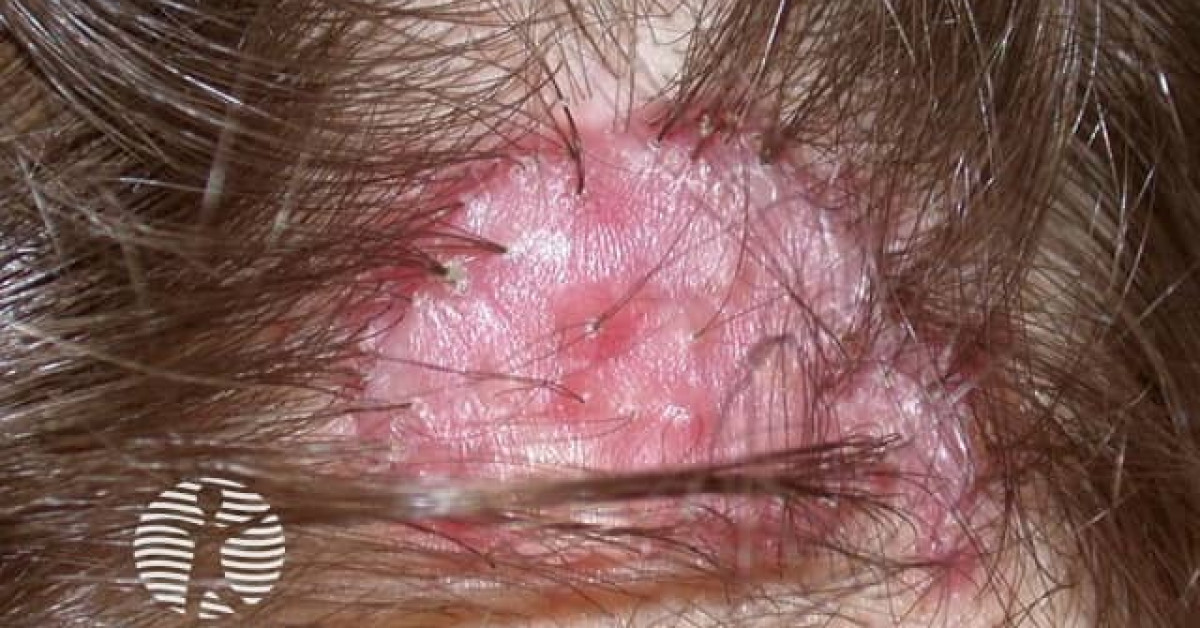 Tufted folliculitis image