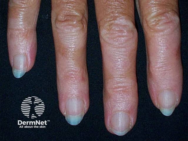 White nail due to vitiligo