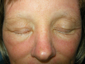 Anagen effluvium: loss of eyebrows from chemotherapy