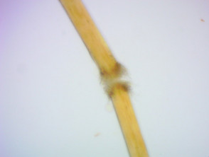 Trichorrhexis in loose anagen hair syndrome