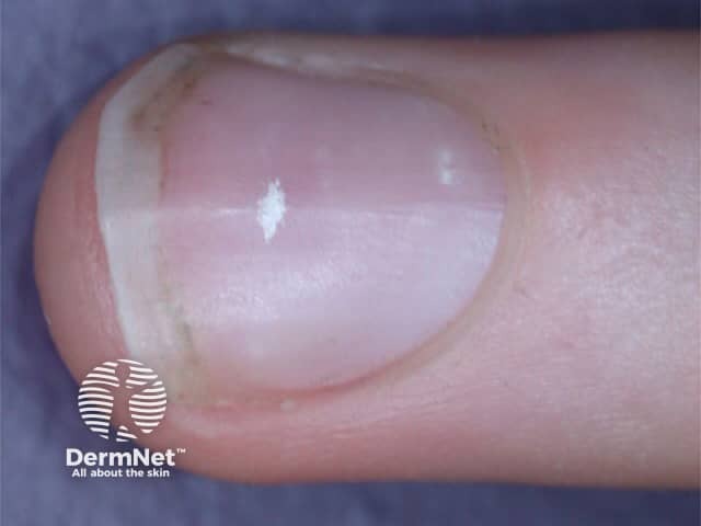 White spots on nails