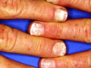 White spots on nail