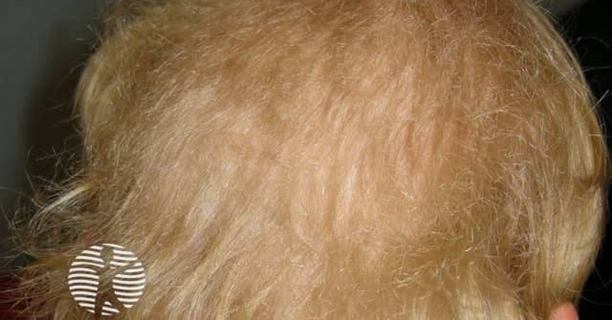 DermNet® - Woolly hair naevus image