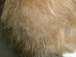 Woolly hair naevus