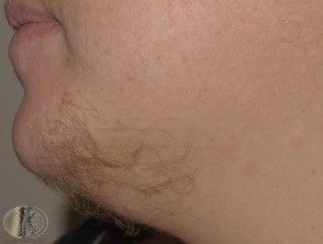 Eruptive vellus hair cysts
