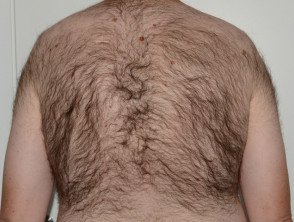 Struggling with Hair Growth In Unwanted Areas Of Your Body Get Yourself  Checked For PCOS