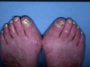 Yellow nail syndrome