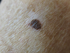 Melanoma with depigmentation