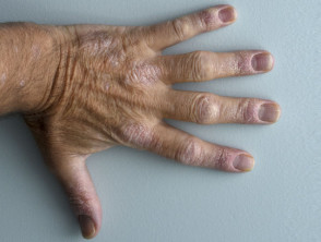 Psoriasis on the dorsal hand