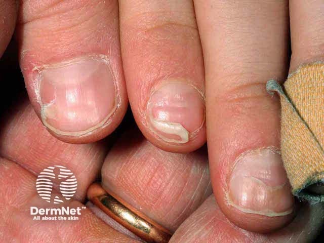 Nail changes noted 6 weeks after hand and mouth blister resolution