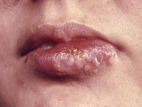 herpes lips