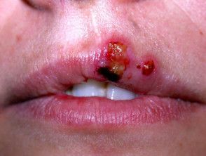 Herpes simplex labialis