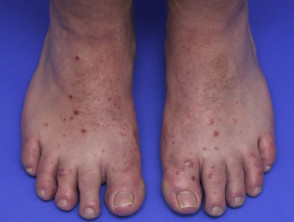 Blisters on foot, in hand foot and mouth disease