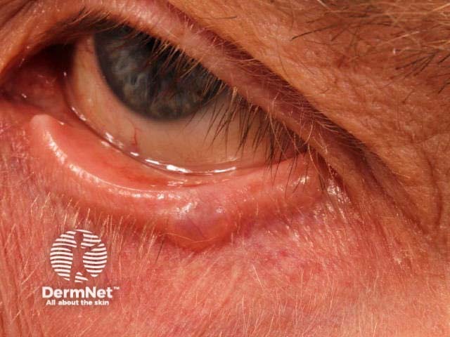 Hidrocystoma of the eyelid