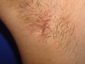 Hidradenitis in adult armpit - Stock Image - C021/5606 - Science Photo  Library