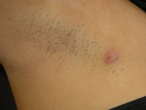 Hidradenitis suppurativa of the armpit - Stock Image - C052/9796 - Science  Photo Library