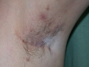 Hidradenitis in adult armpit - Stock Image - C021/5606 - Science Photo  Library