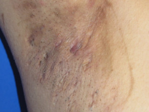 Hidradenitis suppurativa of the armpits - Stock Image - C051/8618