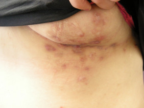Hidradenitis in adult armpit - Stock Image - C021/5606 - Science
