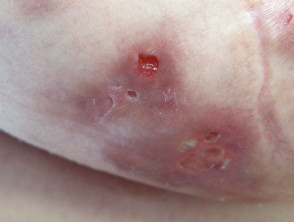 lump on breast : r/Hidradenitis