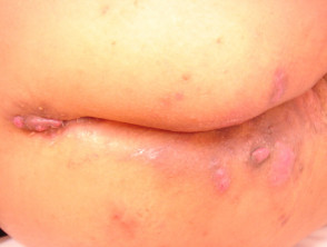 Hidradenitis suppurativa of buttocks