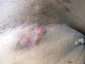 Hidradenitis suppurativa of groin