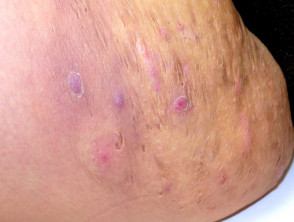 Hidradenitis Suppurativa Inner Thigh Reference Pictures
