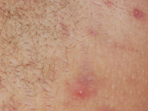 Inflammatory lesion in hidradenitis suppurativa