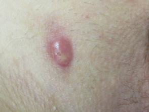 Inflammatory lesion in hidradenitis suppurativa