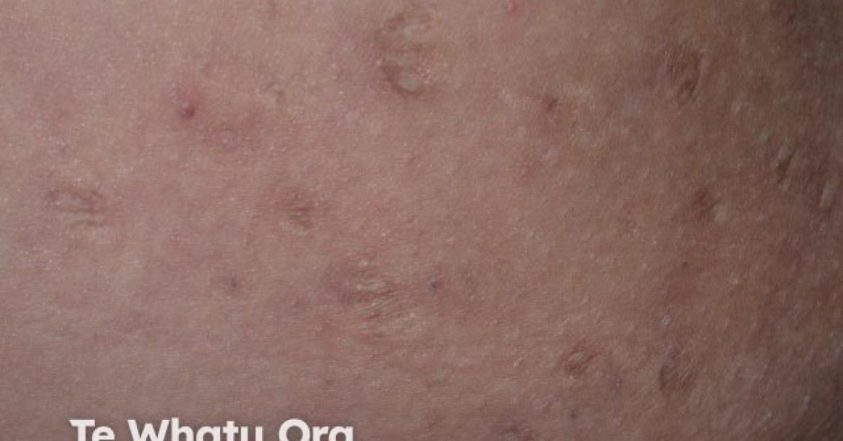 Scarring in hidradenitis suppurativa image