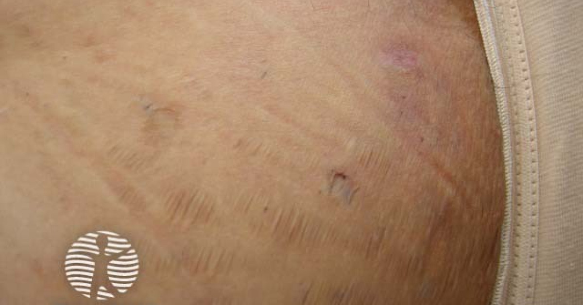 Scarring in hidradenitis suppurativa image