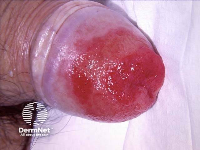 Penile high-grade squamous intraepithelial lesion