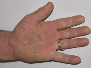 contact dermatitis palms