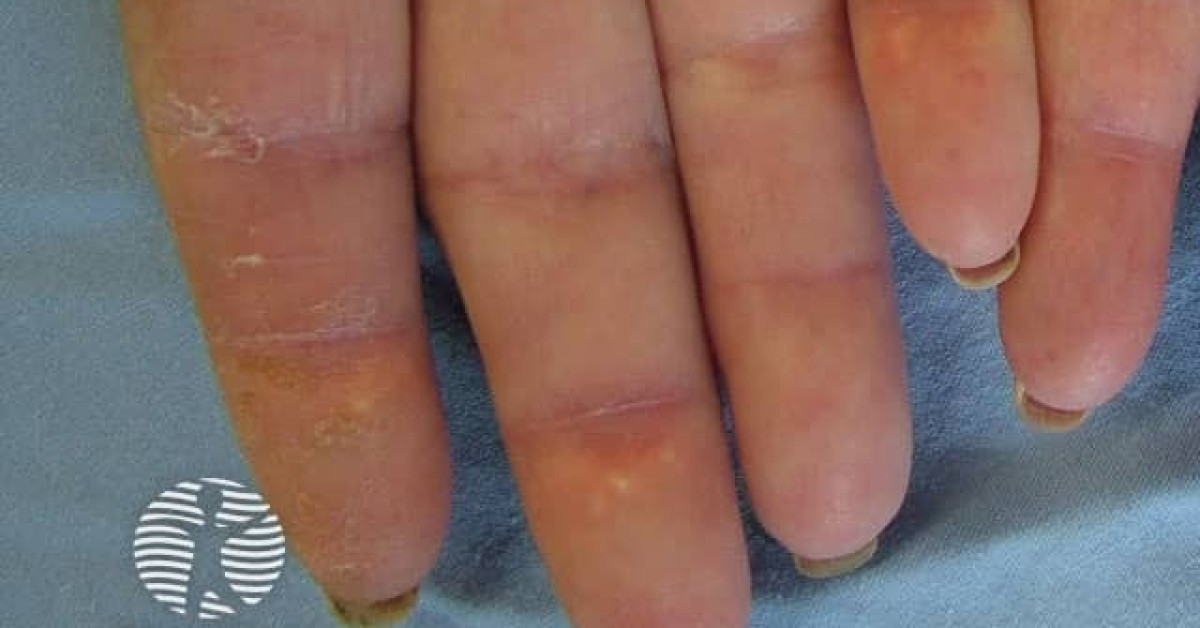 Dermnet® Dermatomyositis Of The Hand Image