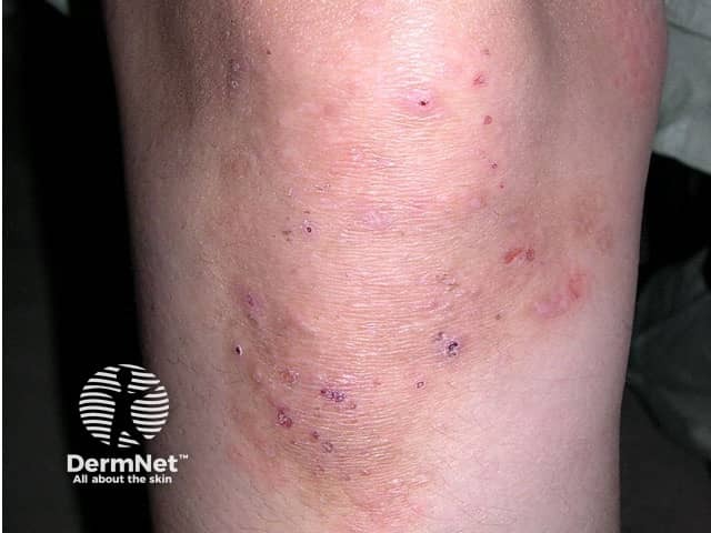 Dermatitis Herpetiformis Features Diagnosis And Treatment DermNet