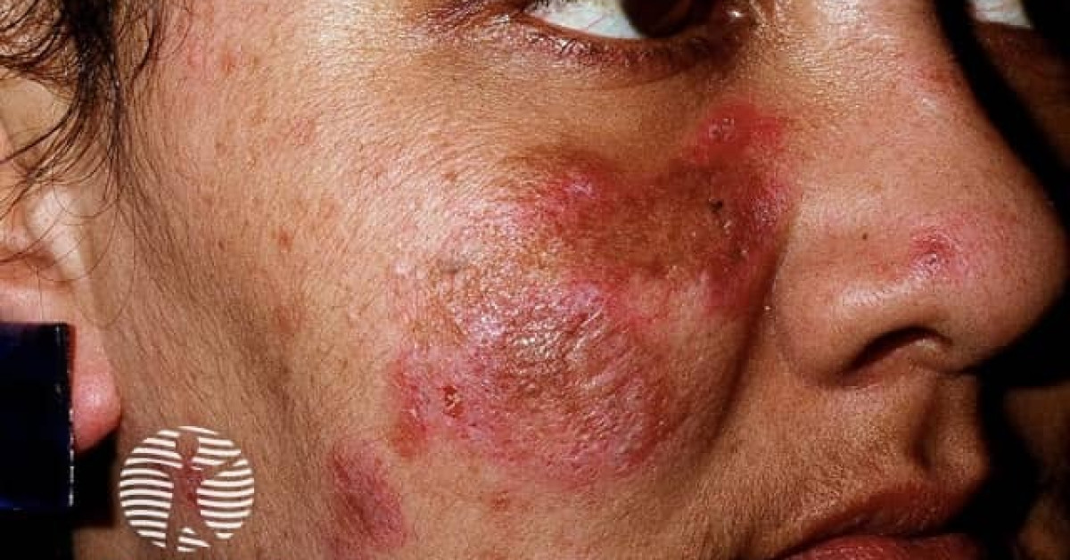 Chronic discoid lupus erythematosus image