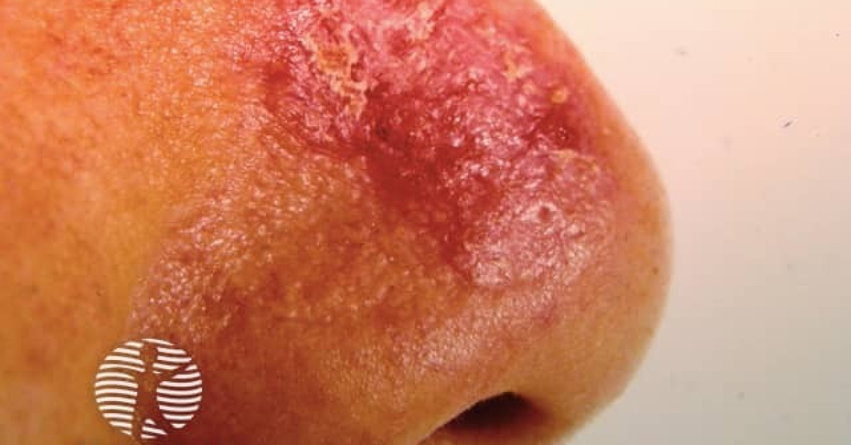 Dermnet chronic discoid lupus erythematosus image