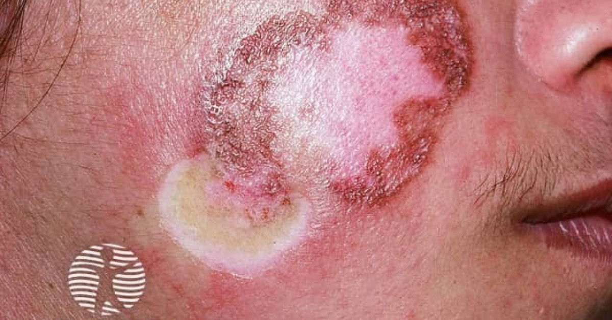 Chronic discoid lupus erythematosus image