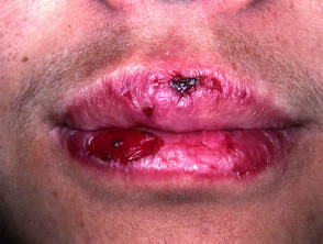 Discoid lupus erythematosus
